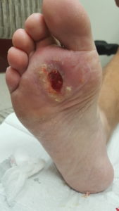 diabetic foot wound