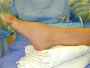 equinus ankle