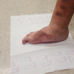 Hallux toe amputation