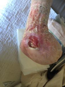 amputation with ulcer