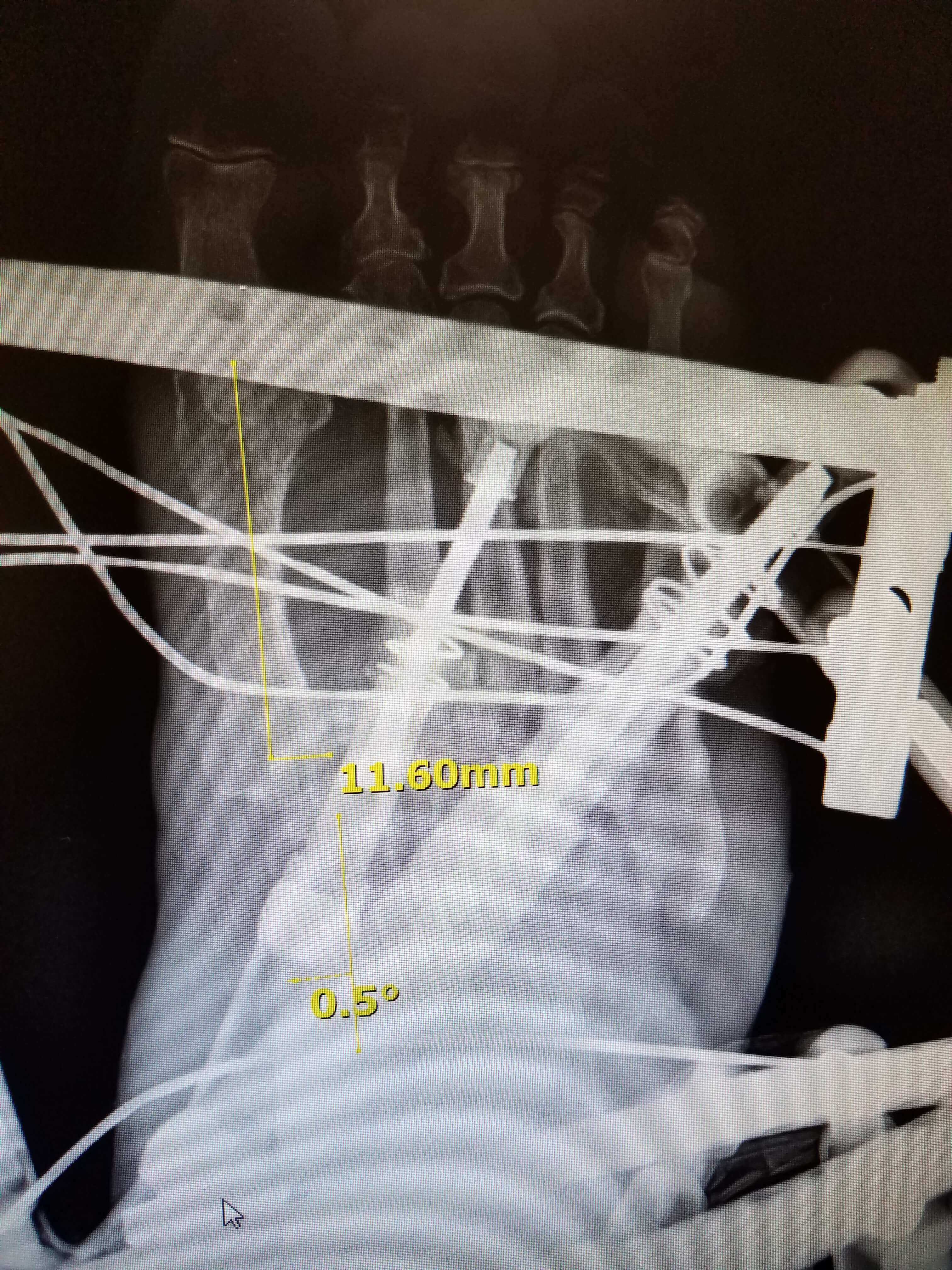 X-ray of a foot with metal pins.