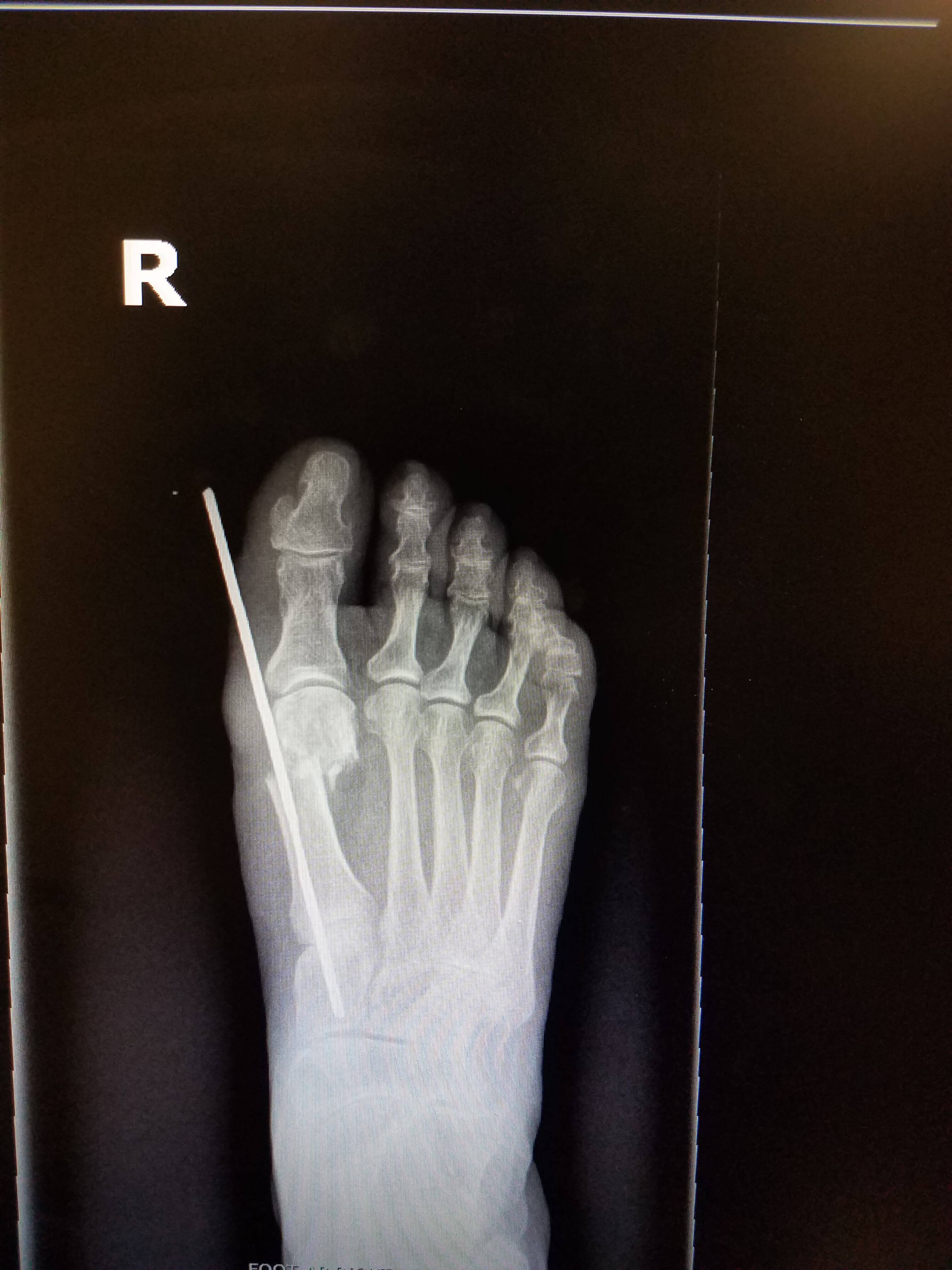 X-ray of a foot with a pin.