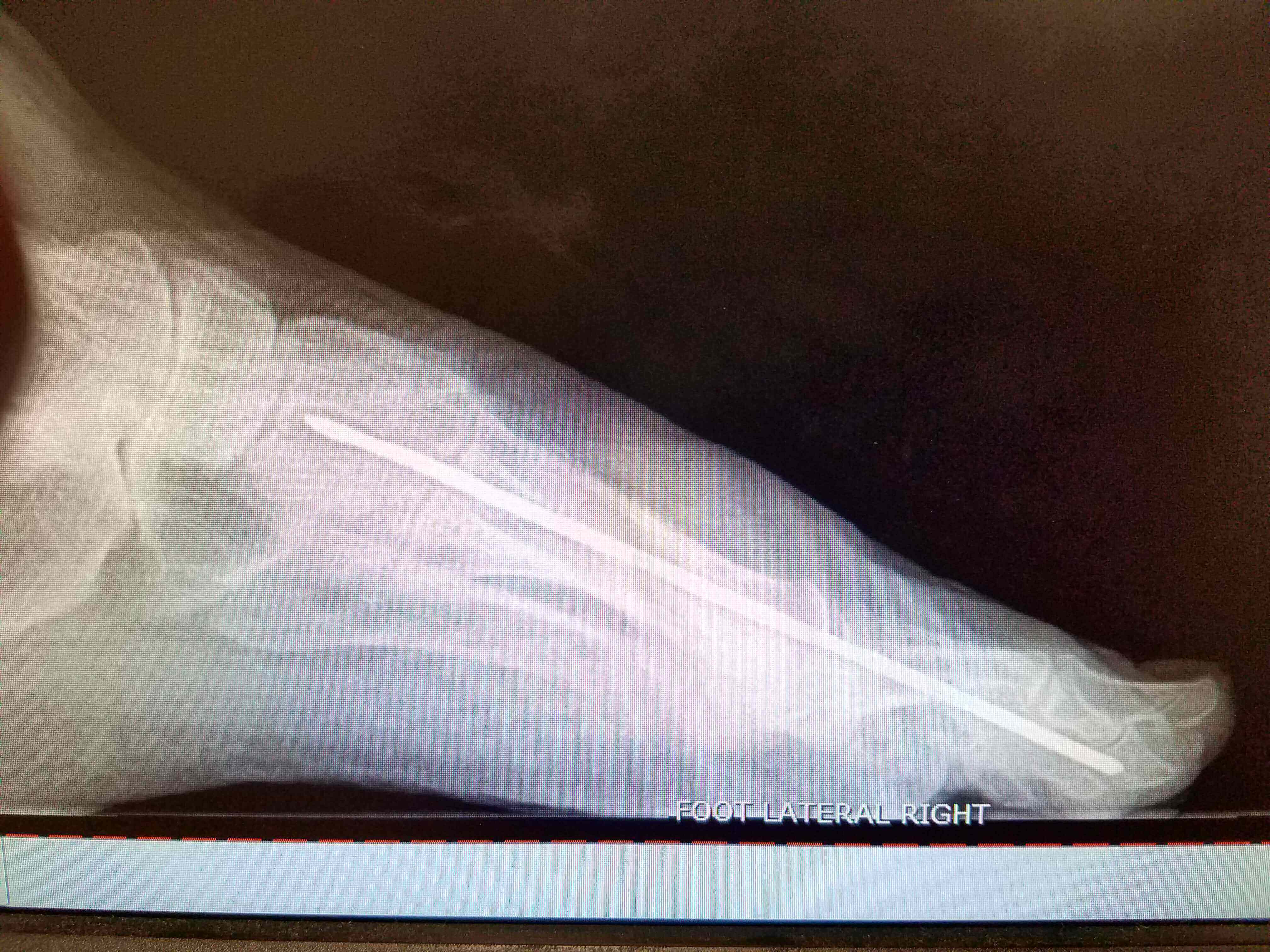 X-ray of right foot with pin.