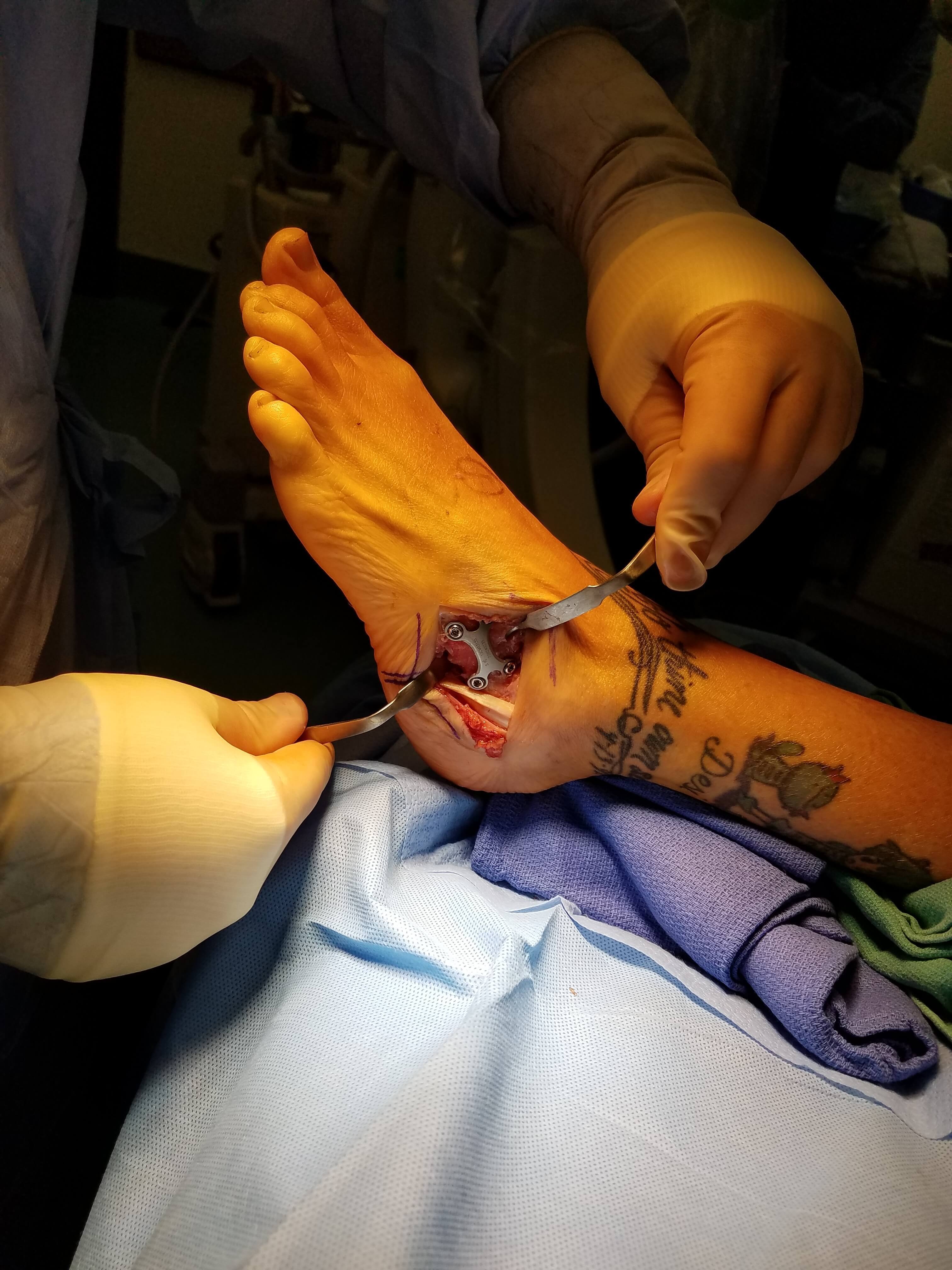 Close-up of foot surgery with metal implants.