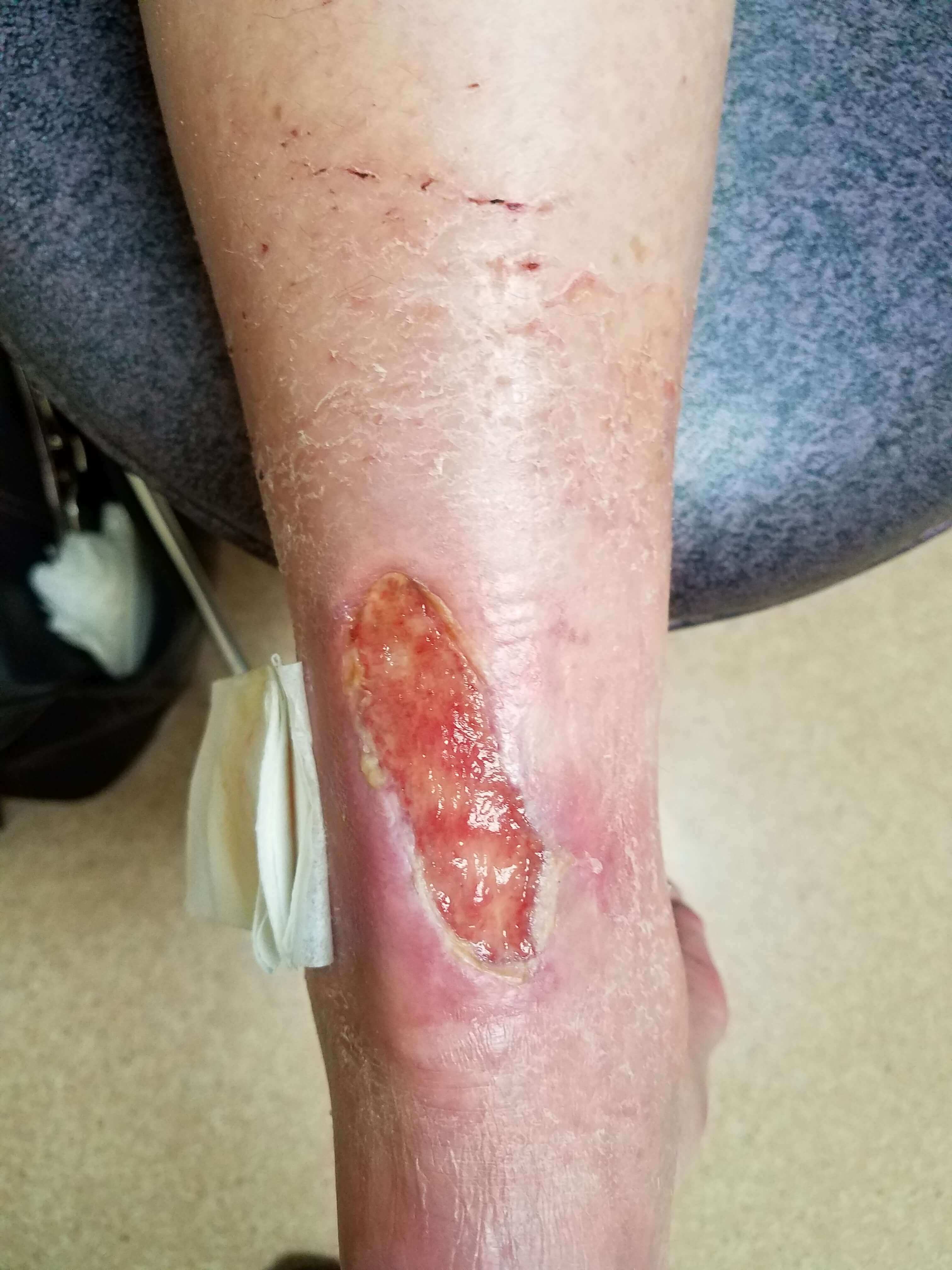 Open shin wound with nearby dressing