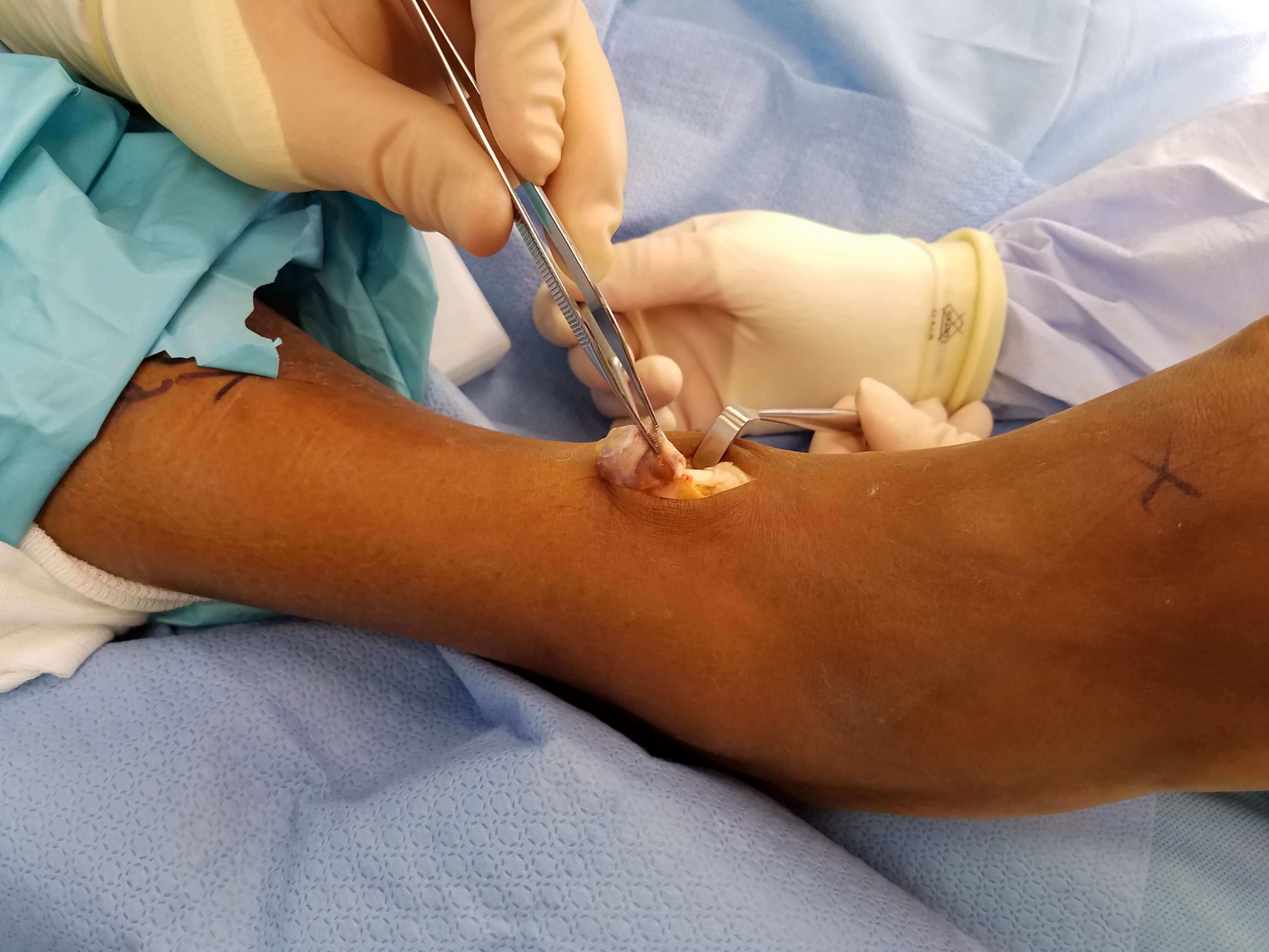 Close-up of a surgical procedure on a forearm.