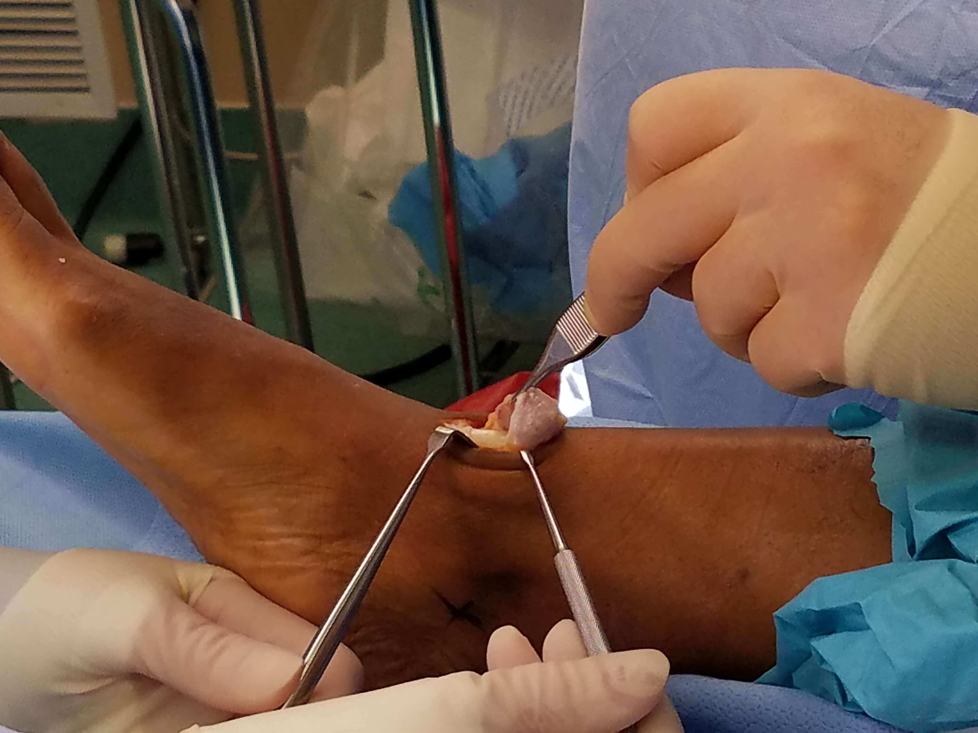 Close-up of ankle surgery with tools.