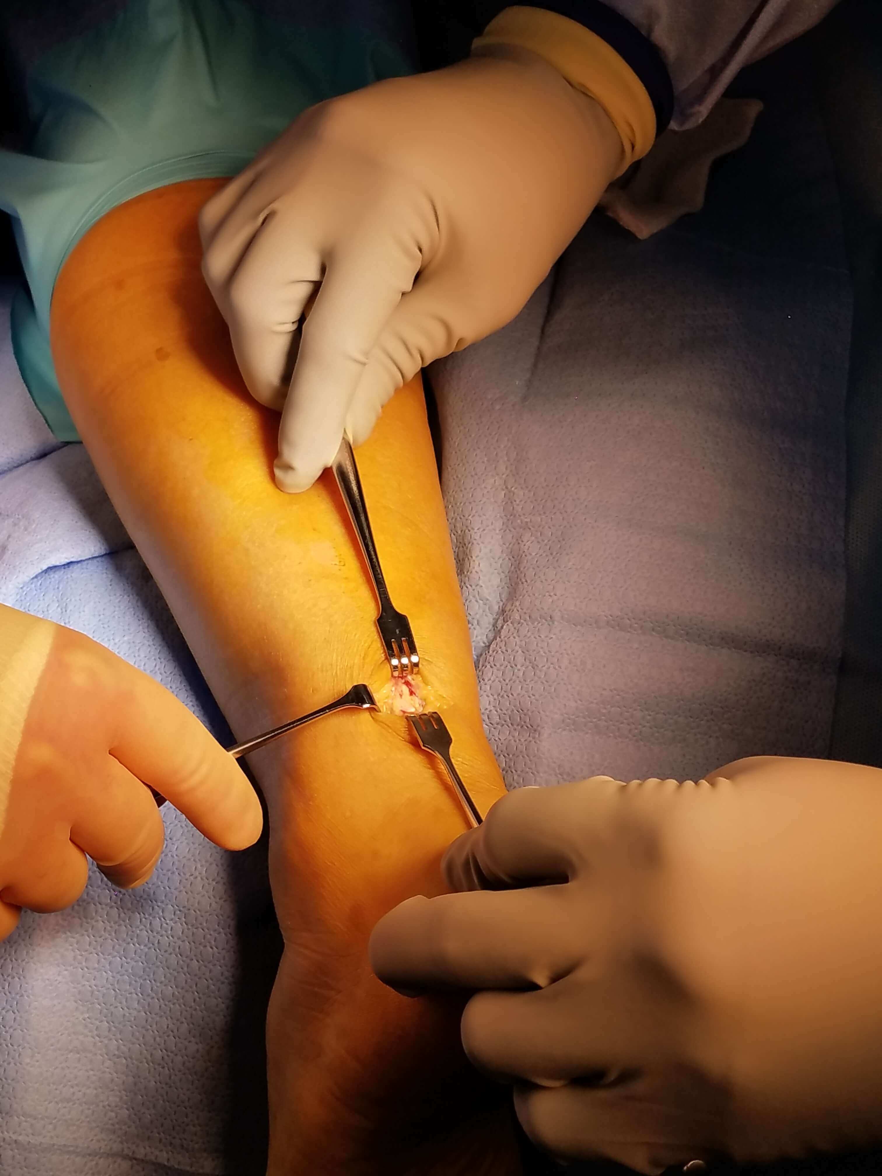 Surgical procedure on a patient's arm.