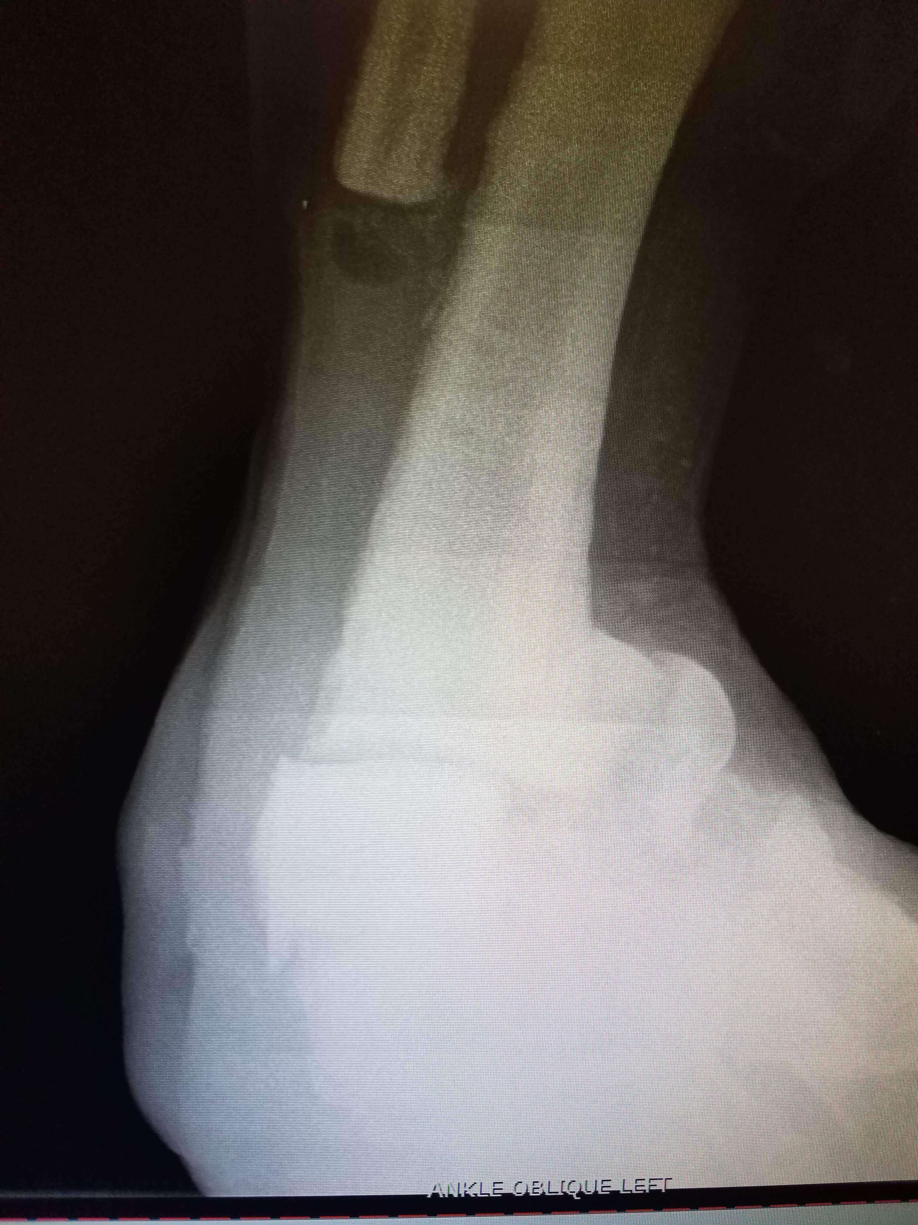 X-ray of a left ankle, oblique view.