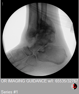 Intraoperative lateral ankle fluoroscopy with guidewire