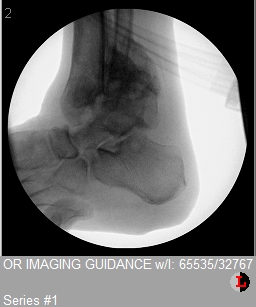 Lateral ankle X-ray with talus and calcaneus