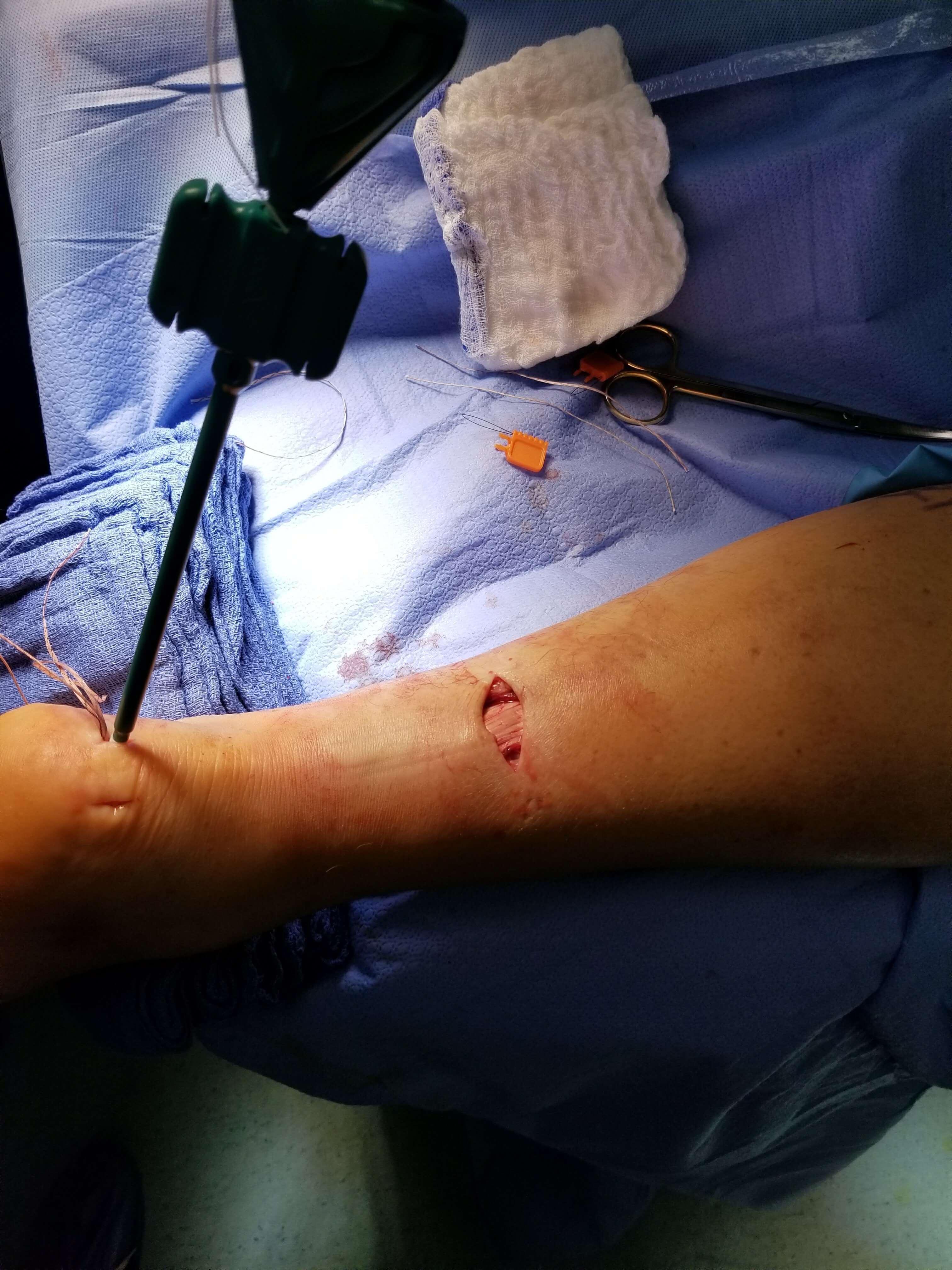 Close-up of a surgical incision on a leg.