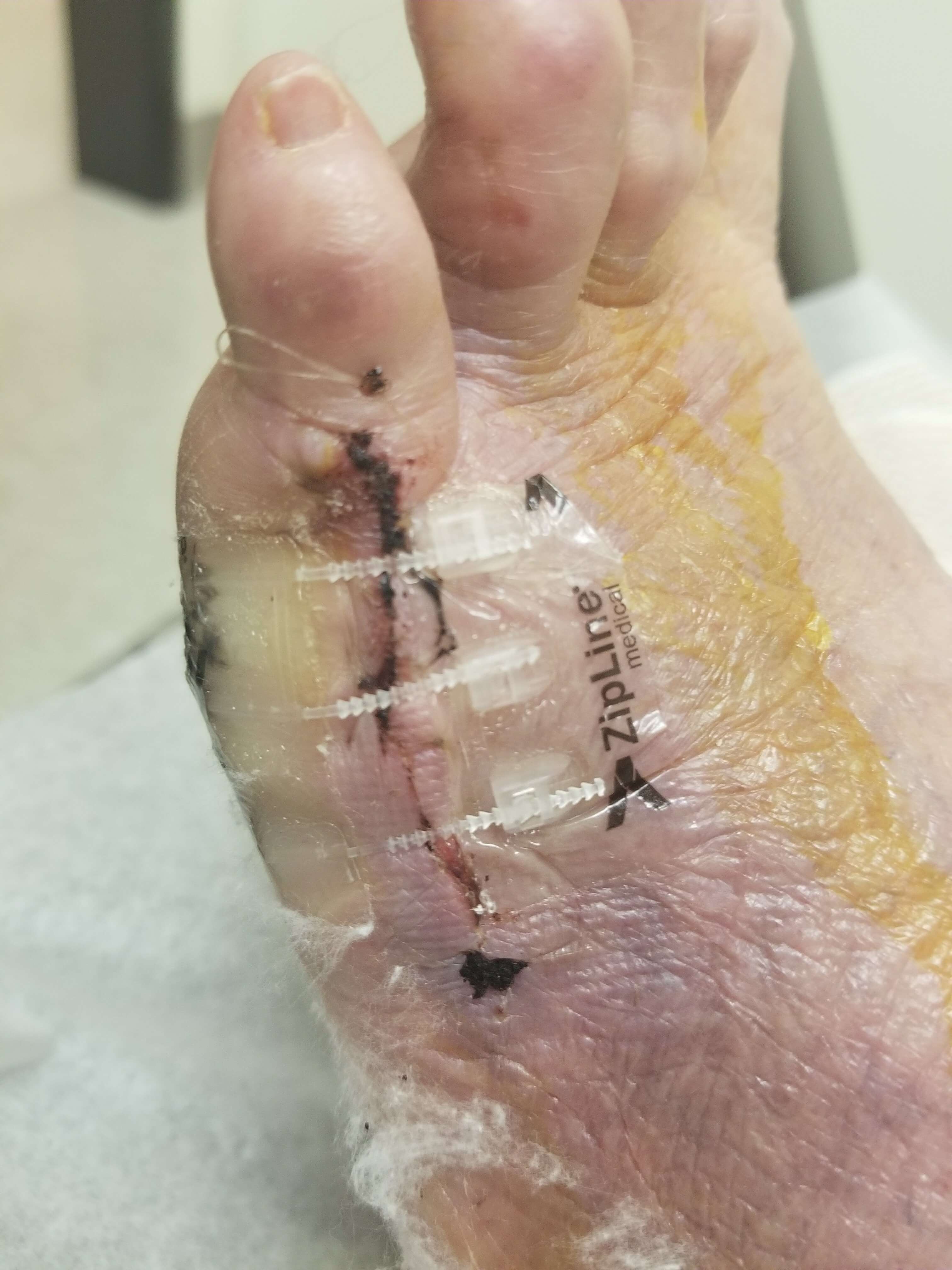 Foot with stitches and Zipline Medical bandage.