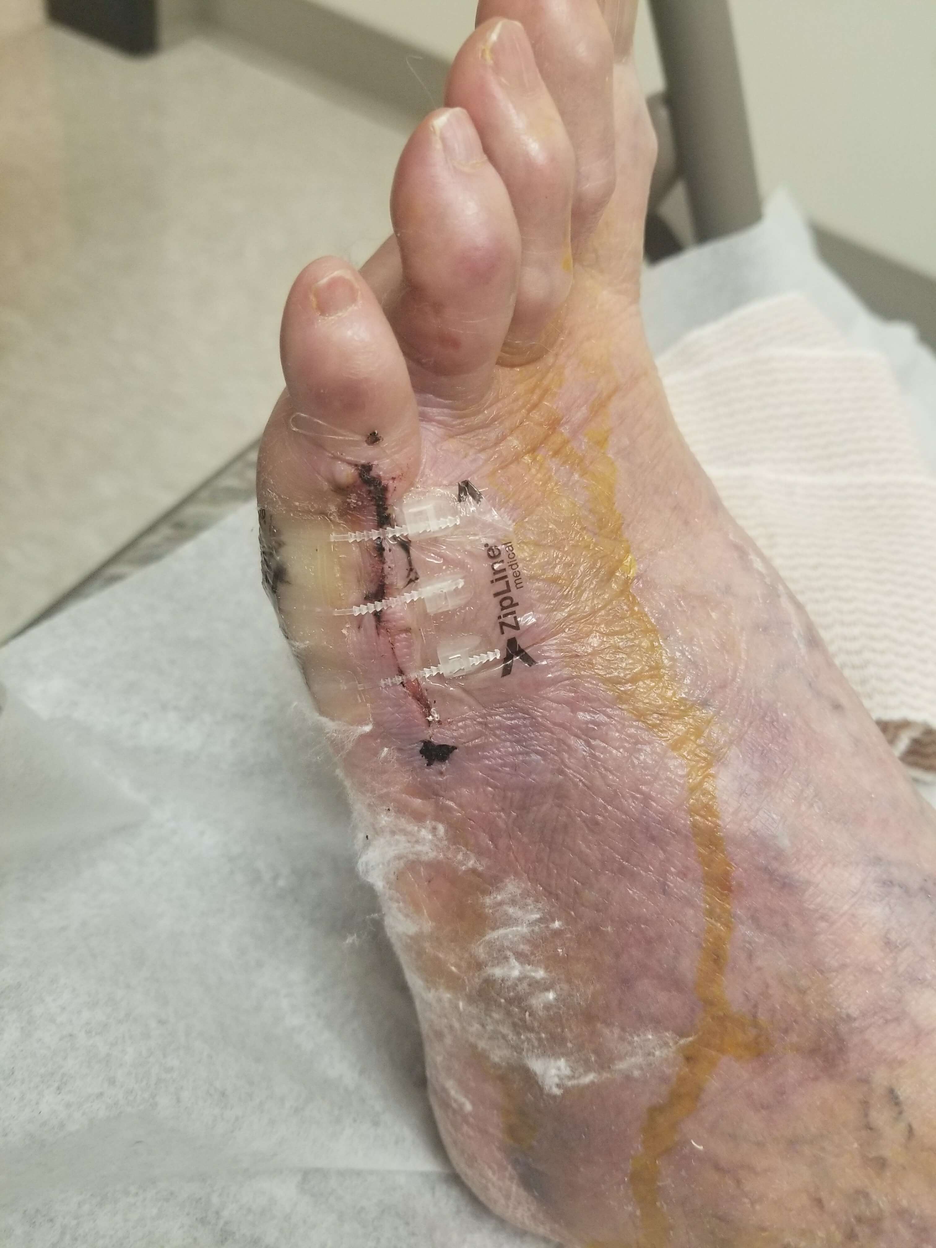 Foot with stitches and medical tape.