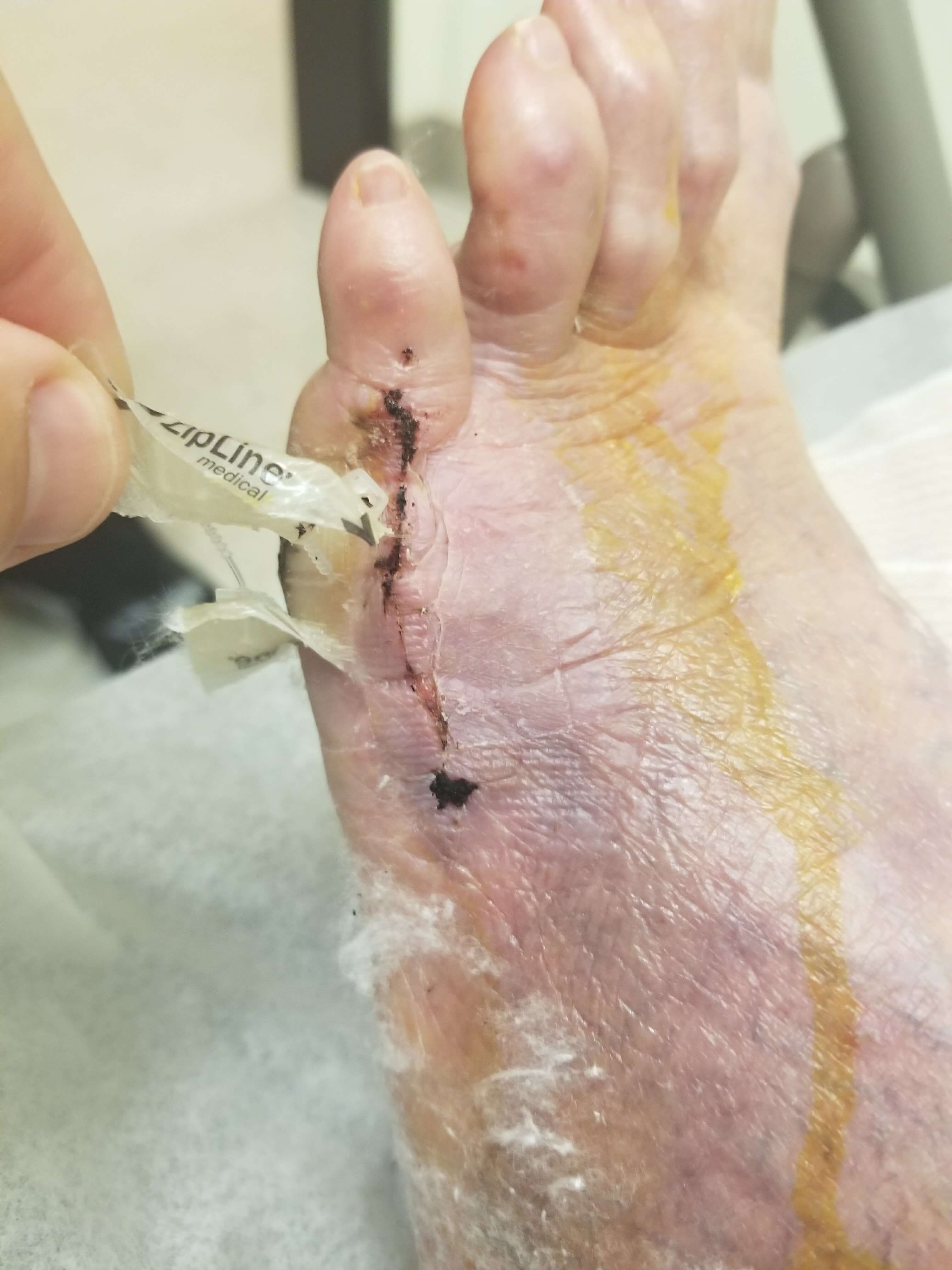 Foot with stitches and bandage being removed.