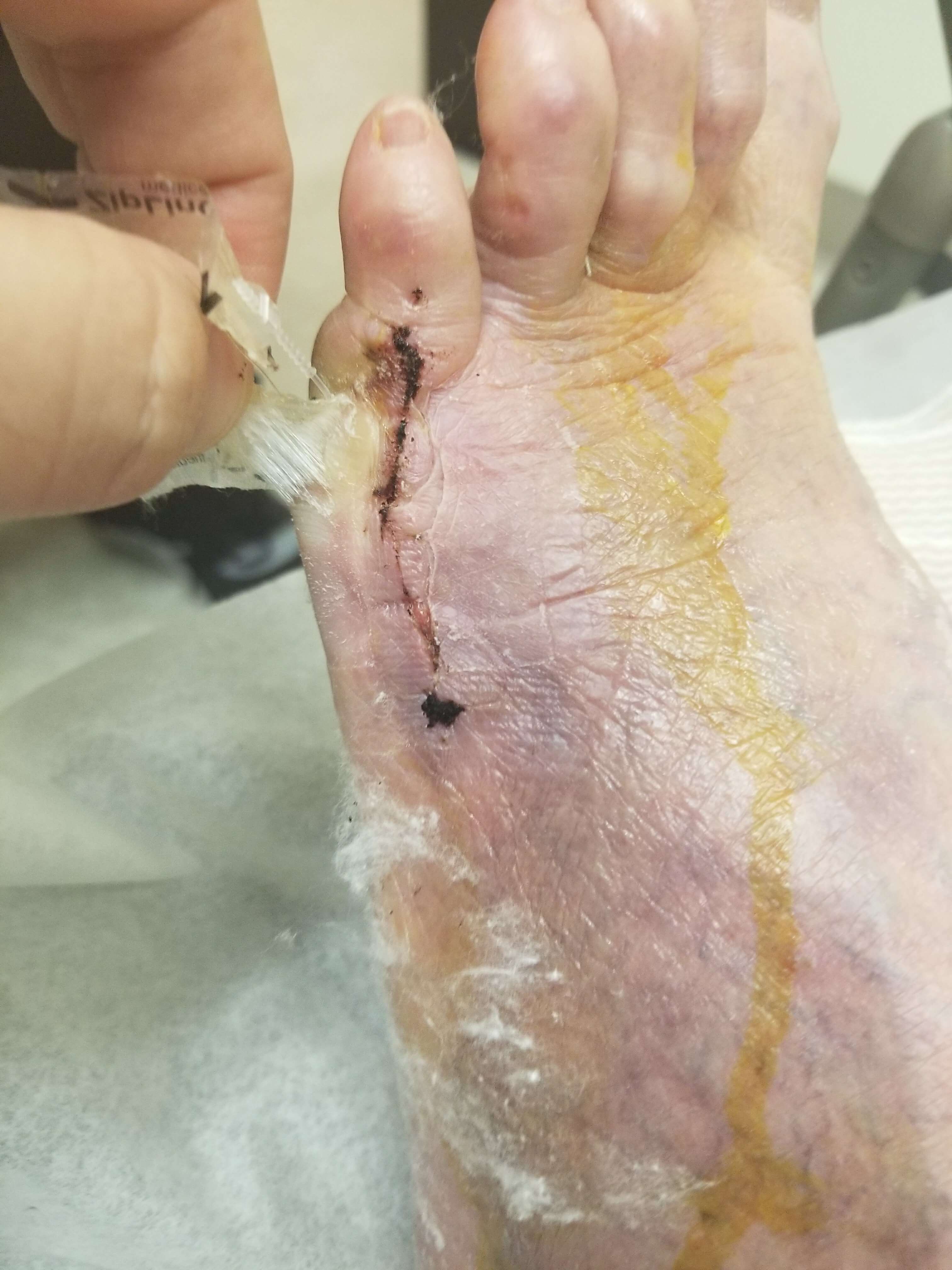 Foot with stitched wound and bandage.