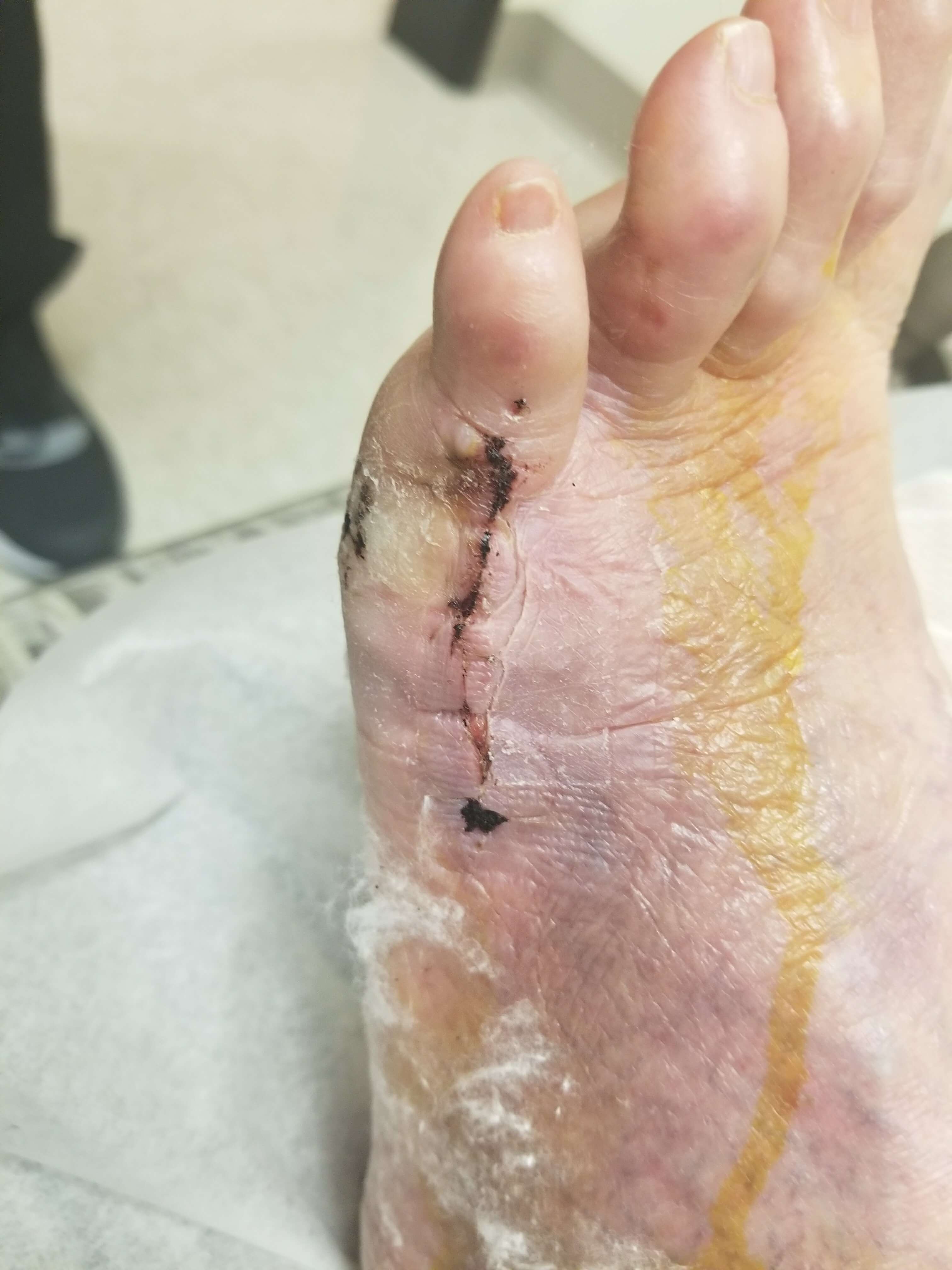 Close-up of a foot with a wound.