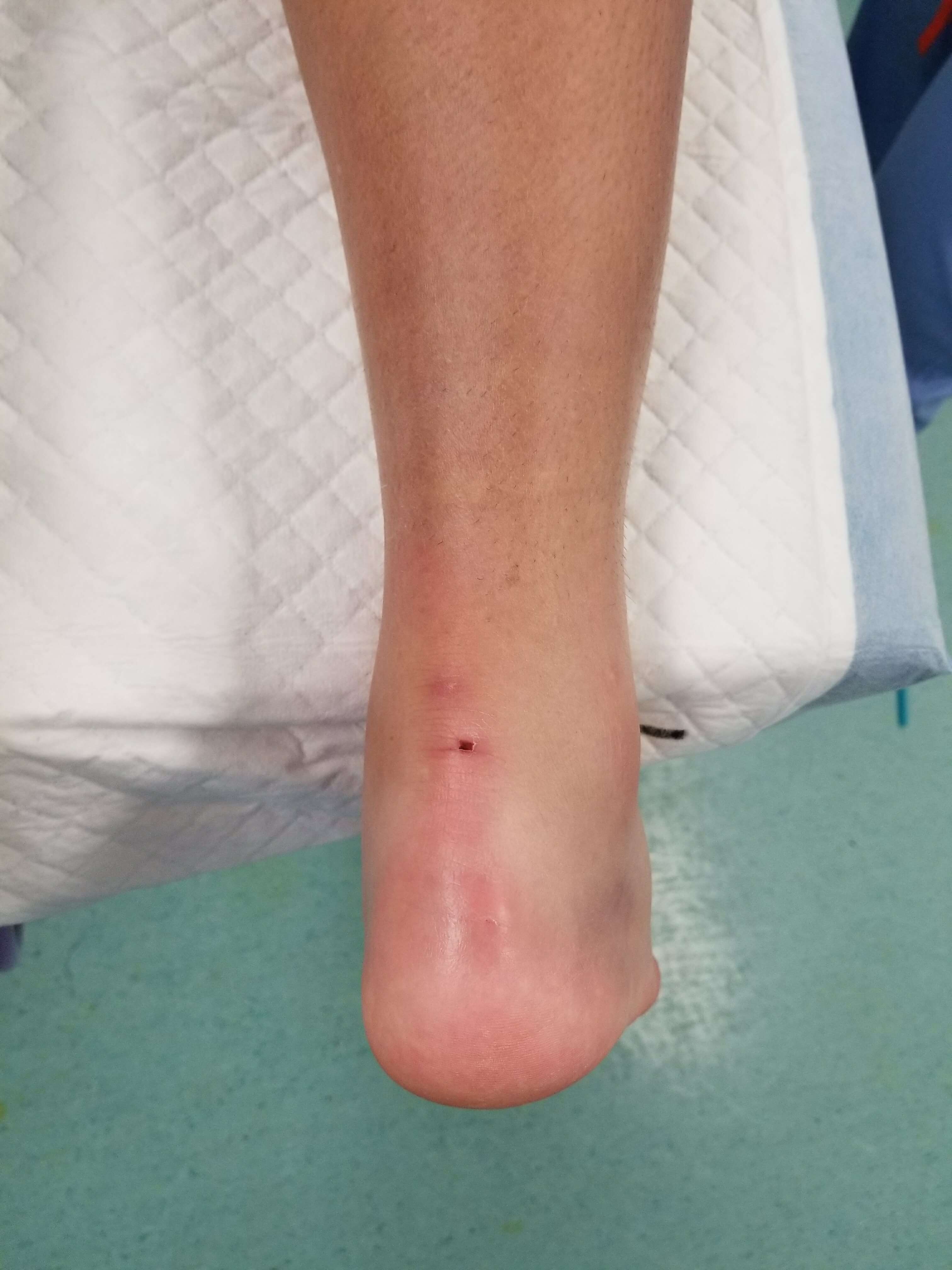 A person's ankle with a bandage.