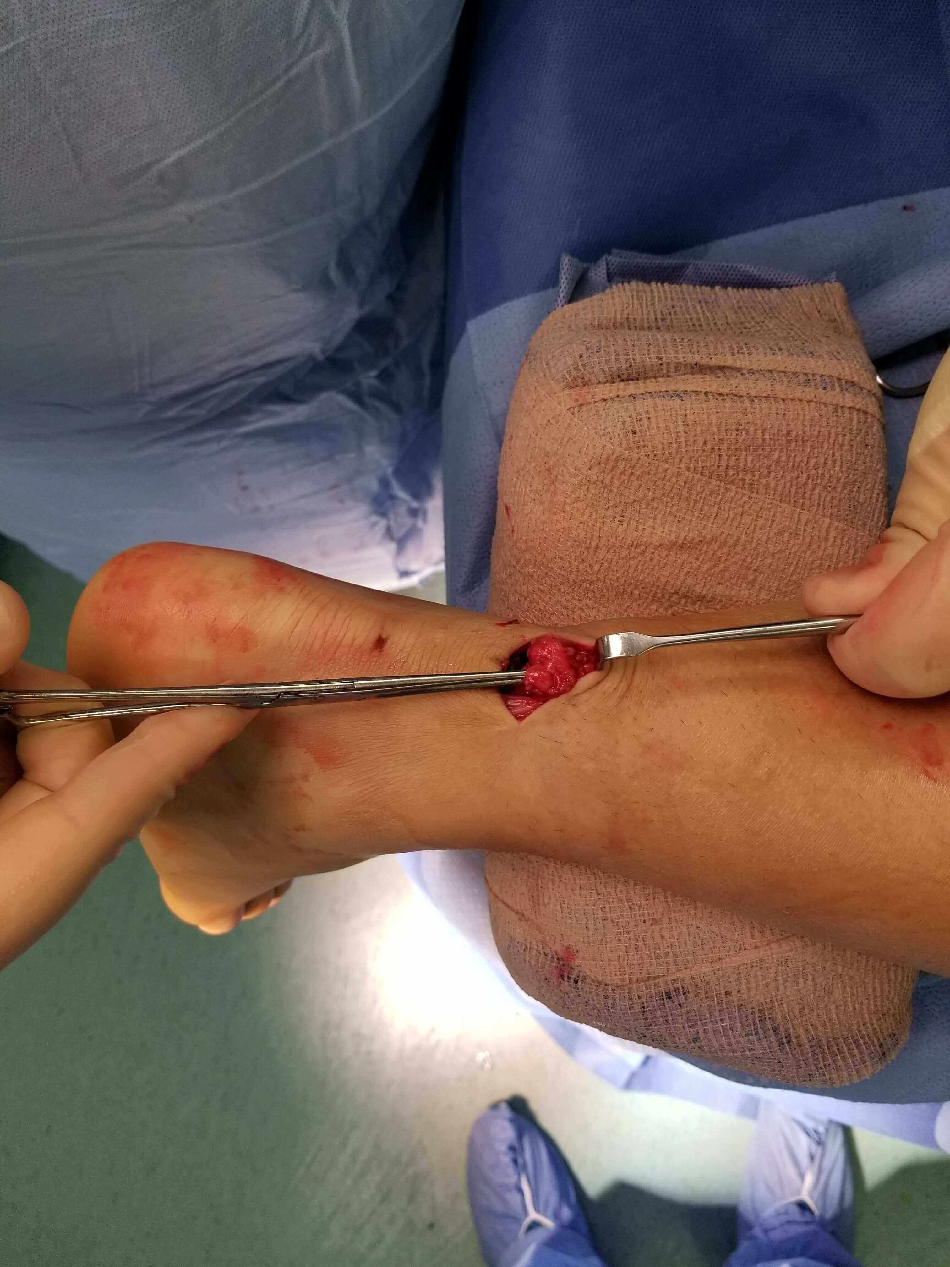Close-up of a surgical incision.
