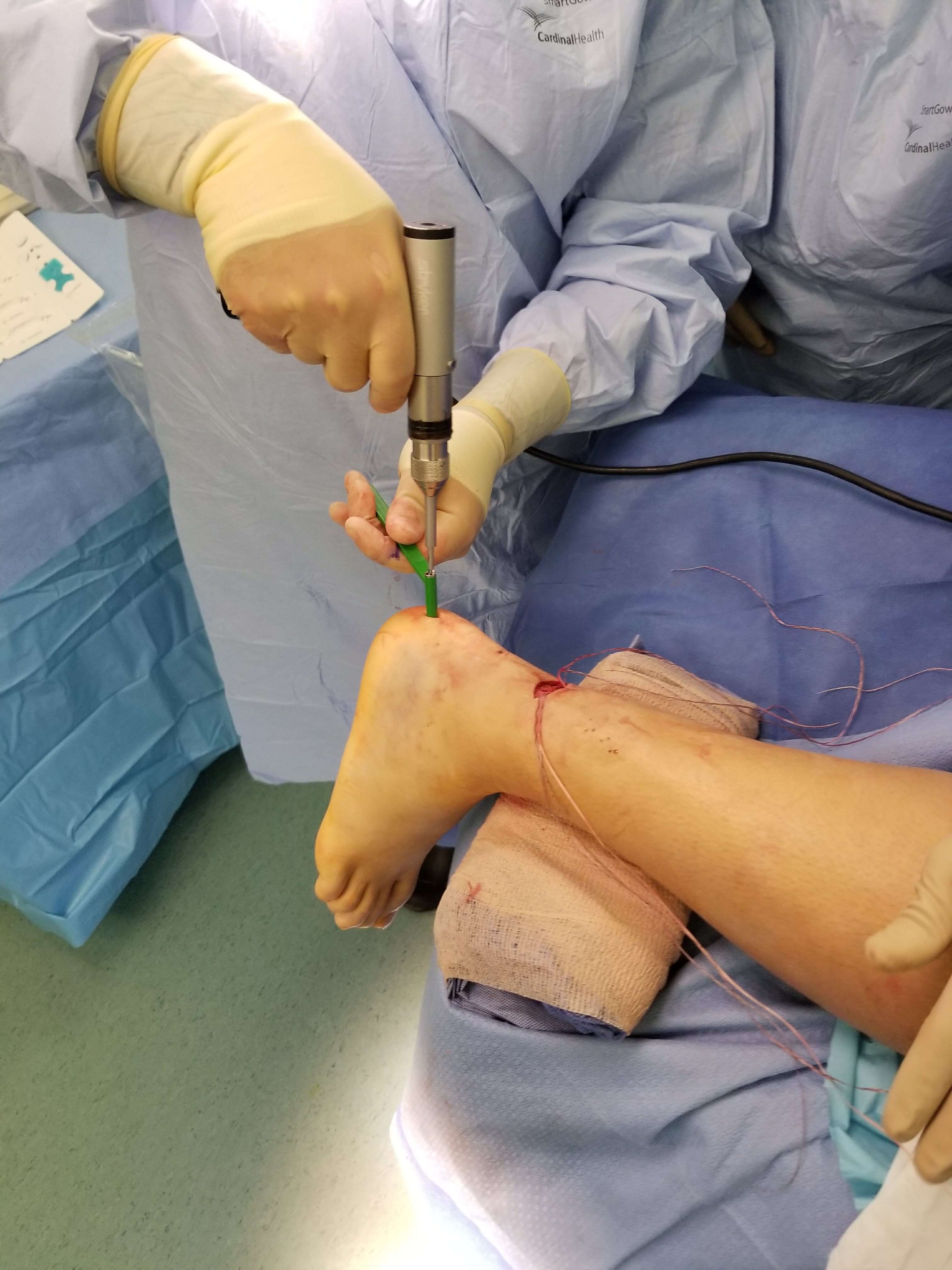 Surgeon performing ankle surgery with tool.