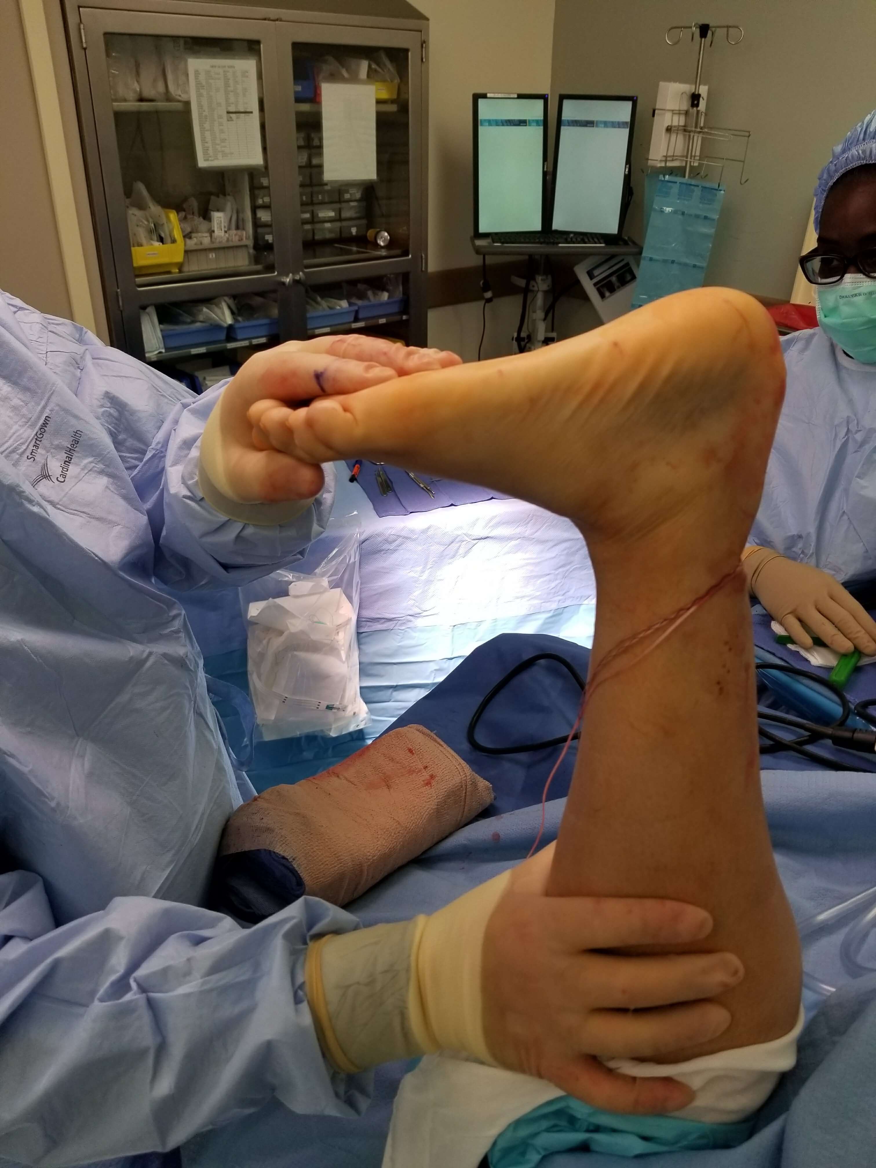 Surgical procedure with leg and foot exposed.