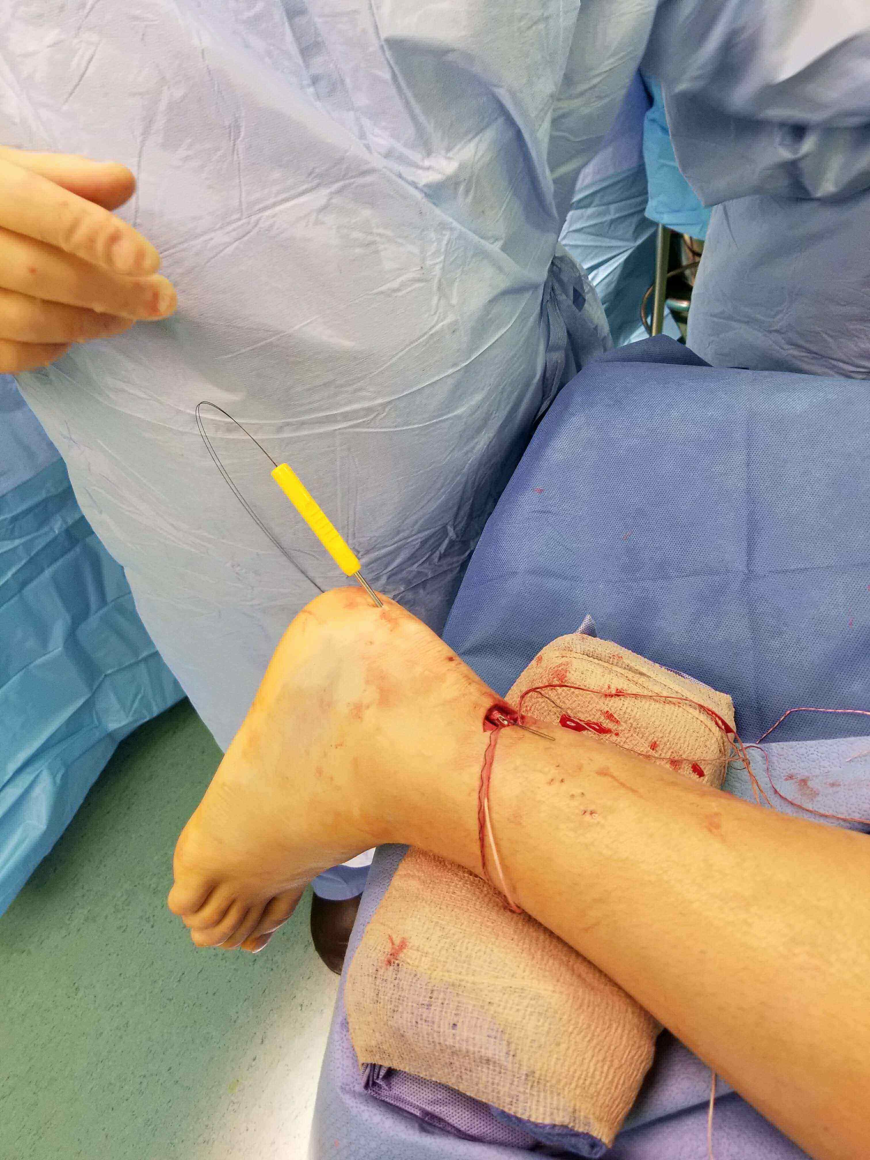 Close-up of a stitched ankle wound.