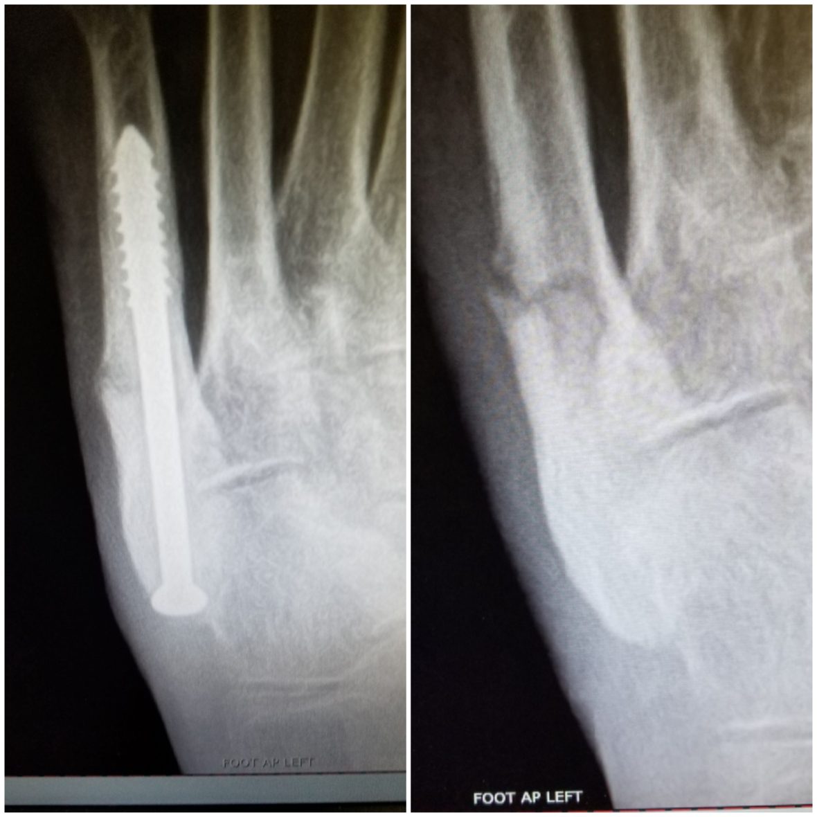 X Ray Image of Foot for Treatment