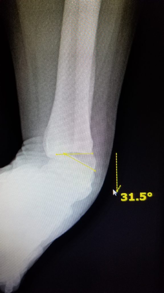 31 degrees tibio talar opening ankle stress inversion X ray