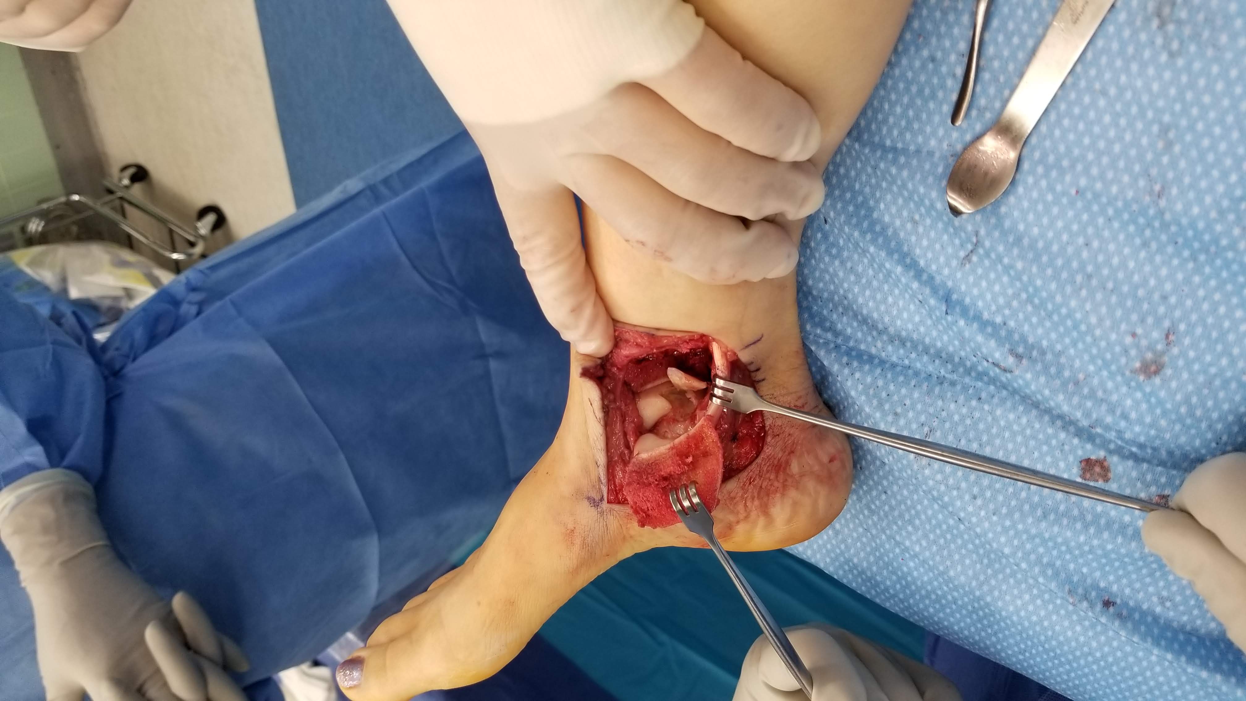 Osteochondral Defect of the Talus