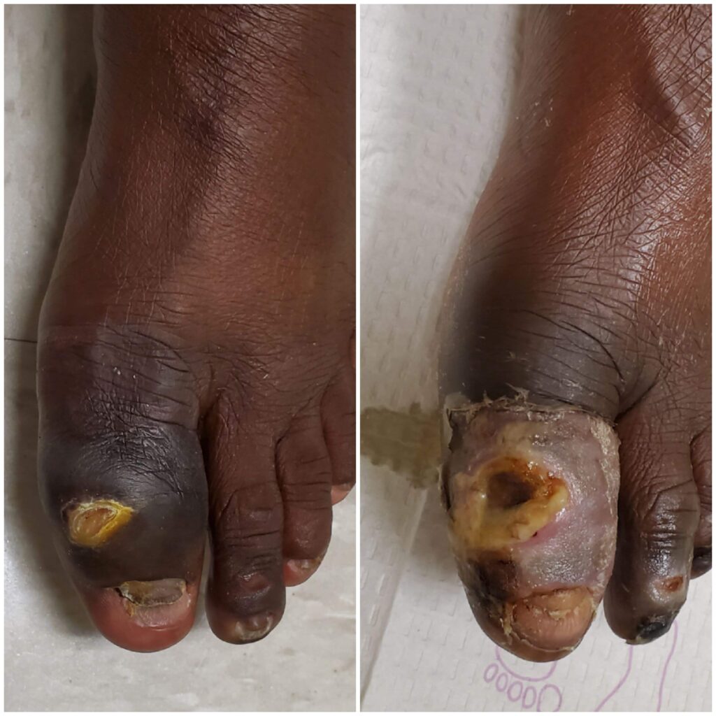 Diabetic toe wound