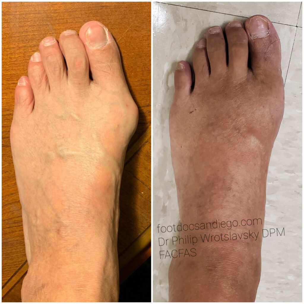 Before and after bunionectomy